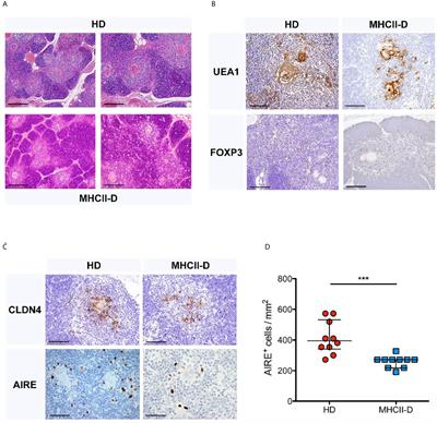 Thymic Epithelial Cell Alterations and Defective Thymopoiesis Lead to Central and Peripheral Tolerance Perturbation in <mark class="highlighted">MHCII</mark> Deficiency